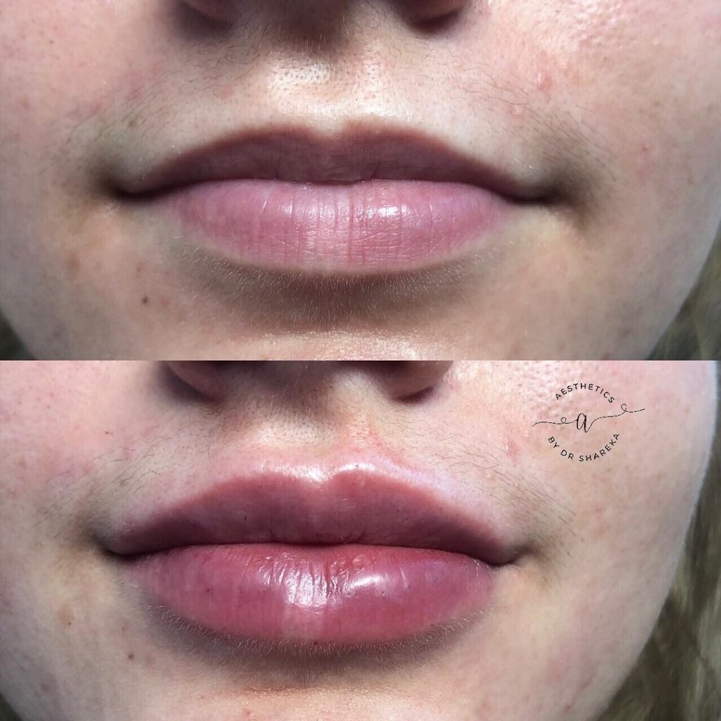 Lip Augmentation Treatments in Cheam Aesthetics by Dr